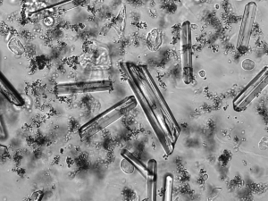 Struvite crystals (urine) - Strüvit kristalleri (idrar) - 02