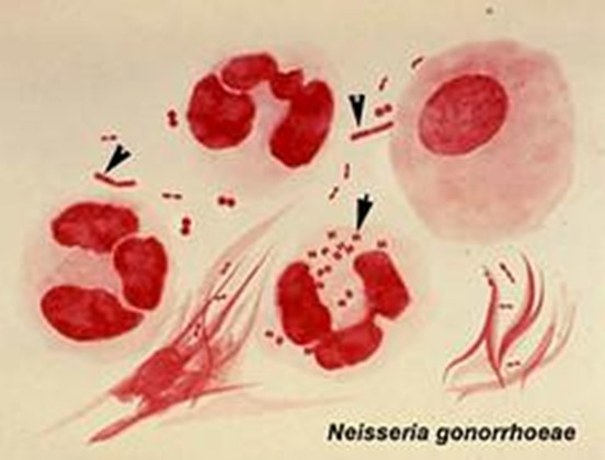 Neisseria Gonorrhoeae