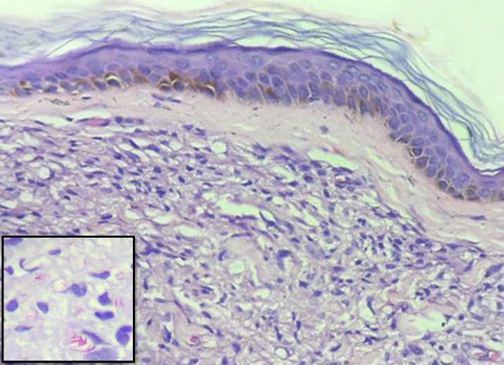 Mycobacterium Leprae