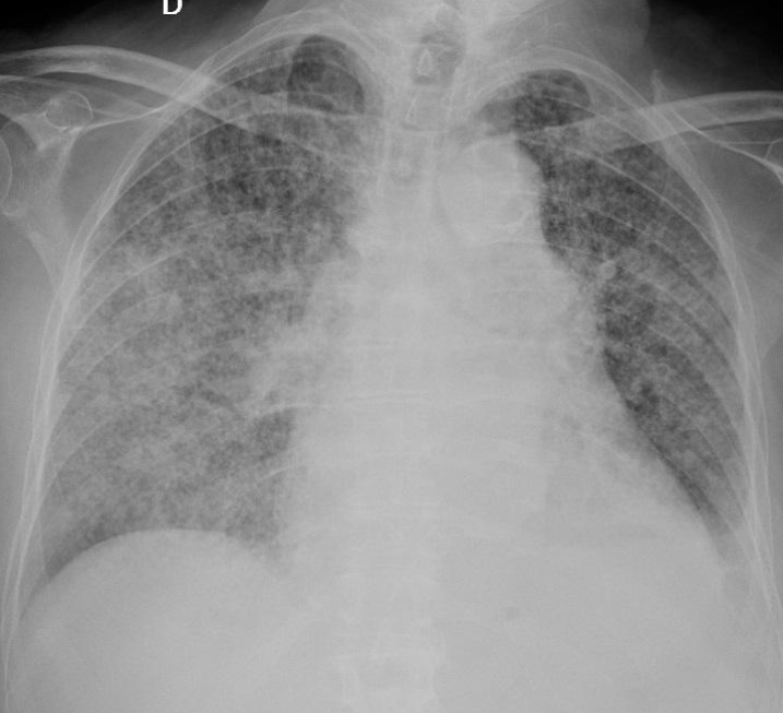 Mycobacterium Tuberculosis