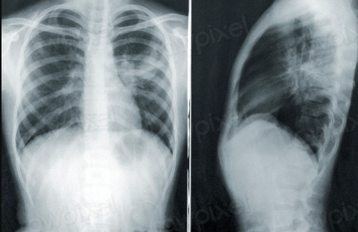 Mycoplasma Pneumoniae